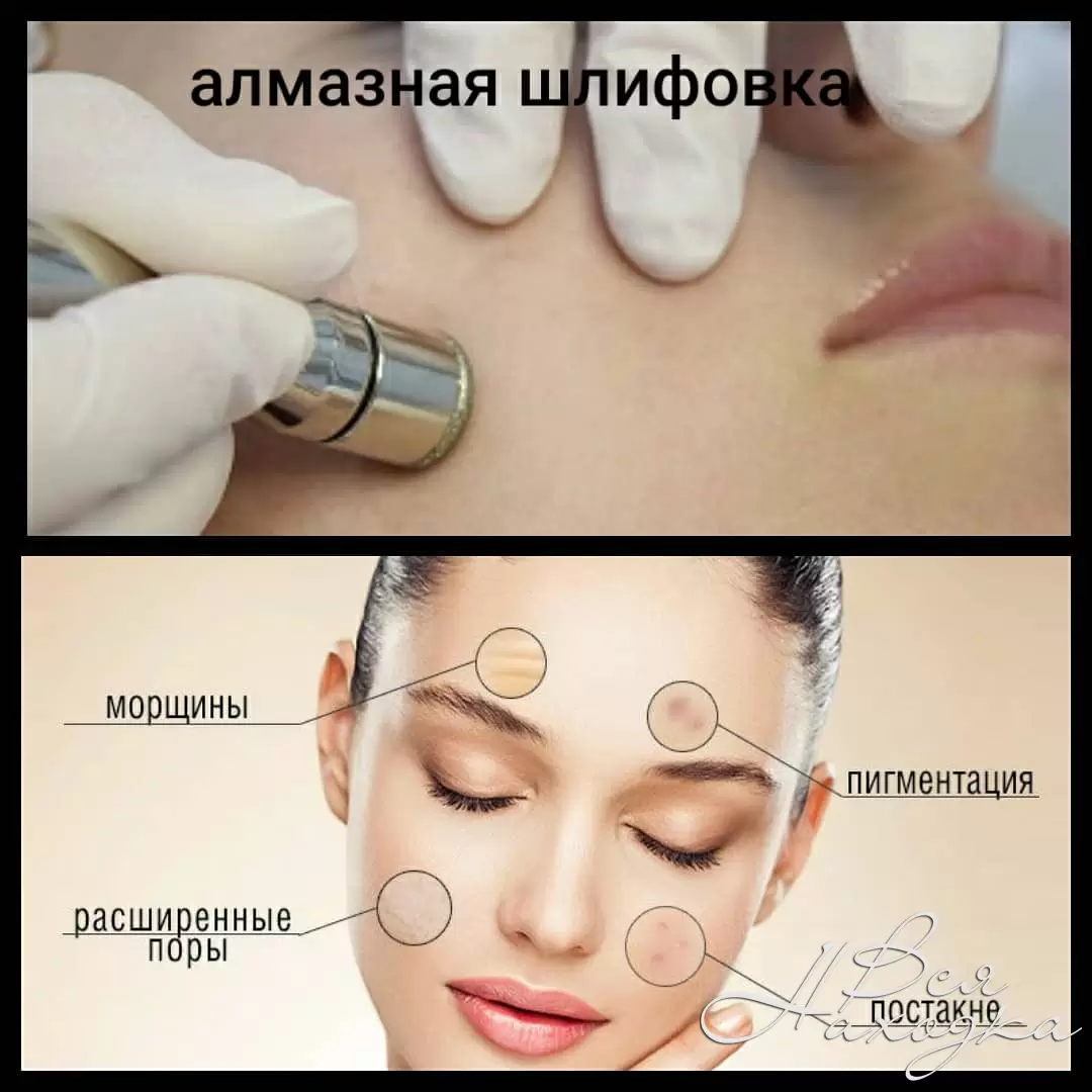 Алмазный Пилинг Лица Фото